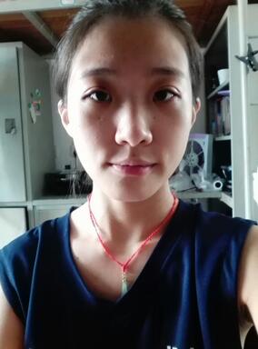 双眼皮15天恢复记录