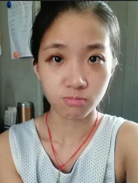 双眼皮15天恢复记录