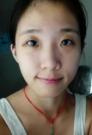 双眼皮15天恢复记录