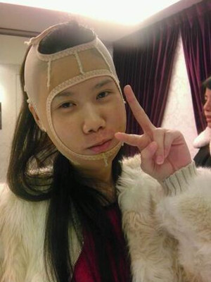 磨了下颌角和颧骨的我 变成小仙女了