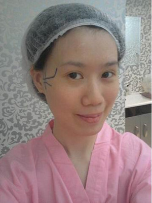 磨了下颌角和颧骨的我 变成小仙女了