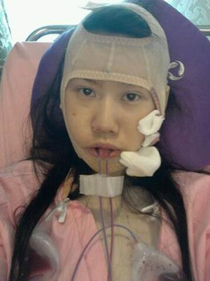 磨了下颌角和颧骨的我 变成小仙女了