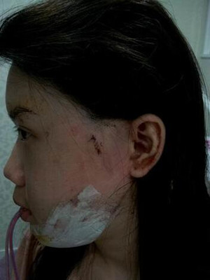 磨了下颌角和颧骨的我 变成小仙女了