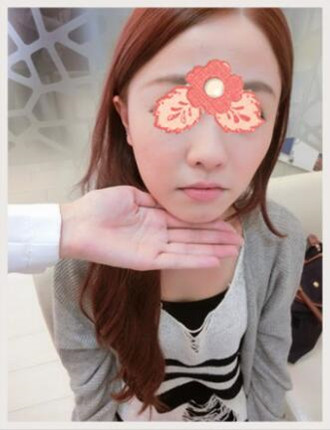 埋埋蛋白线.提升拯救了我的大小脸和皮肤下垂