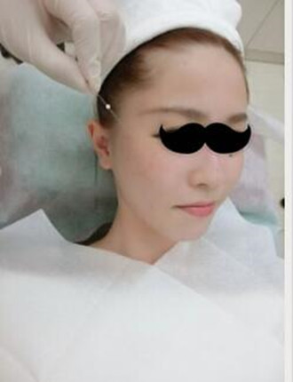 埋埋蛋白线.提升拯救了我的大小脸和皮肤下垂