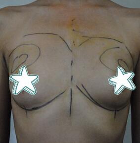 成都艾米丽自体脂肪丰胸前后对比