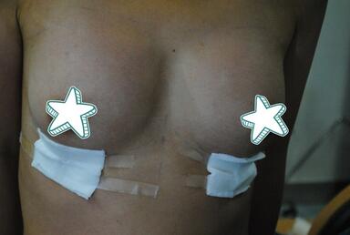 成都艾米丽自体脂肪丰胸前后对比