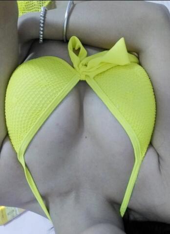 成都艾米丽自体脂肪丰胸前后对比