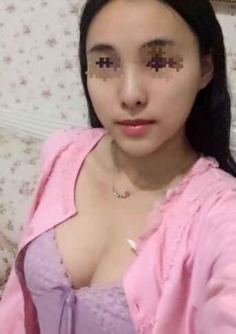 艾米丽自体脂肪隆胸恢复经历