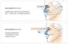 自体软骨隆鼻可以维持多久时间？