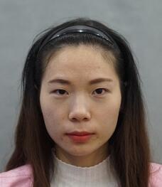 长沙美之峰重睑+开眼角恢复过程图