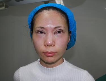 长沙美之峰重睑+开眼角恢复过程图