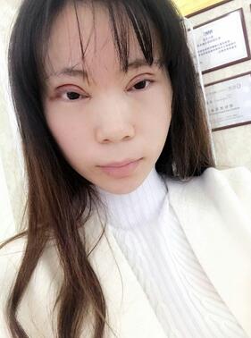 长沙美之峰重睑+开眼角恢复过程图