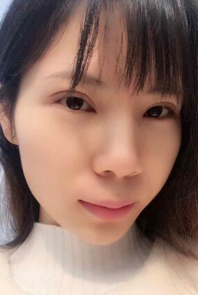 长沙美之峰重睑+开眼角恢复过程图