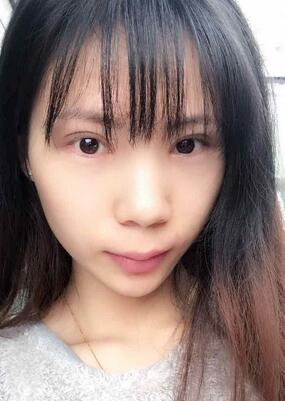 长沙美之峰重睑+开眼角恢复过程图