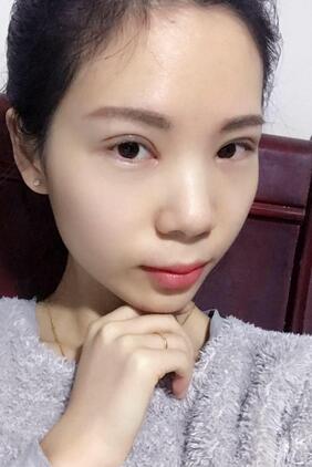 长沙美之峰重睑+开眼角恢复过程图