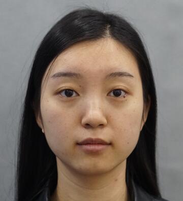 长沙美之峰割双眼皮3个月了