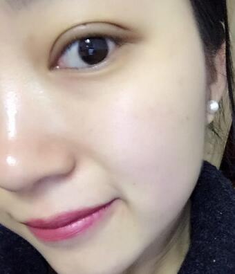 长沙美之峰割双眼皮3个月了