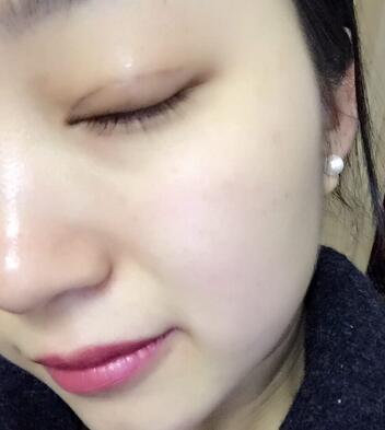 长沙美之峰割双眼皮3个月了