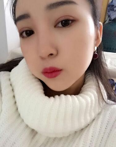 长沙美之峰割双眼皮3个月了