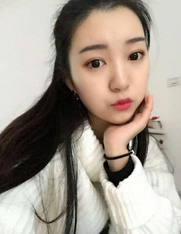 长沙美之峰割双眼皮3个月了
