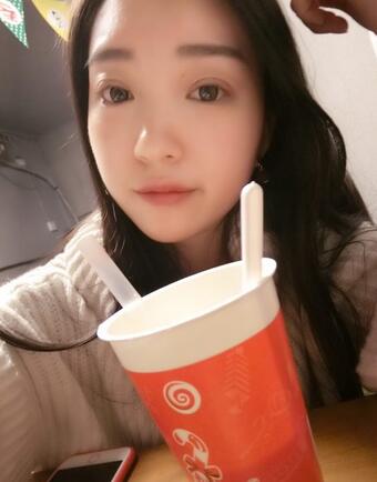 长沙美之峰割双眼皮3个月了