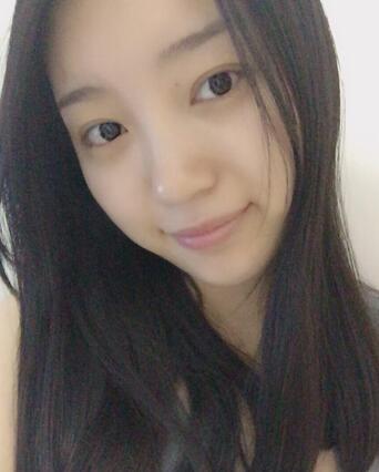 长沙美之峰割双眼皮3个月了