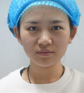 长沙美之峰假体隆鼻恢复日记