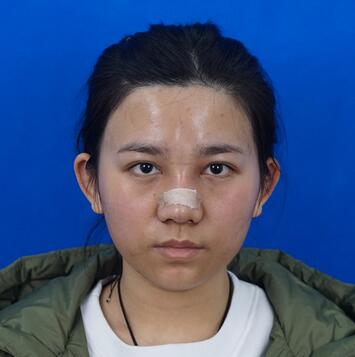 长沙美之峰假体隆鼻恢复日记