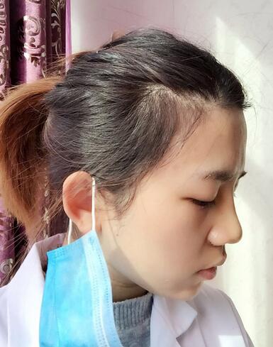 长沙美之峰假体隆鼻恢复日记