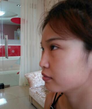 长沙美之峰隆鼻整形手术恢复日记图