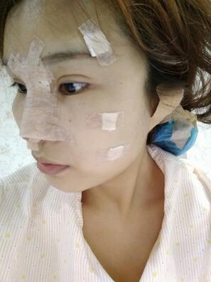 长沙美之峰隆鼻整形手术恢复日记图