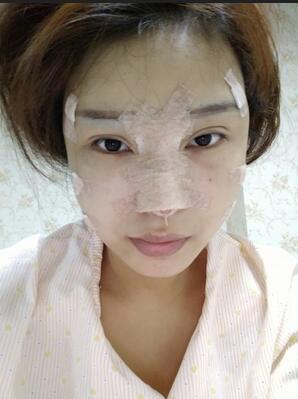 长沙美之峰隆鼻整形手术恢复日记图