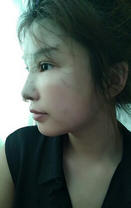 长沙美之峰隆鼻整形手术恢复日记图