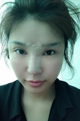 长沙美之峰隆鼻整形手术恢复日记图