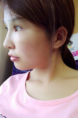 长沙美之峰隆鼻整形手术恢复日记图