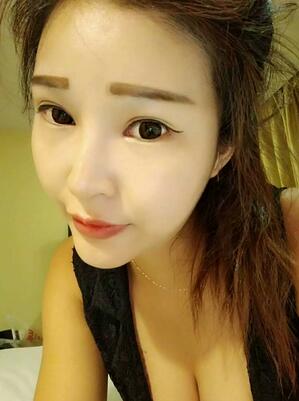 长沙美之峰隆鼻整形手术恢复日记图