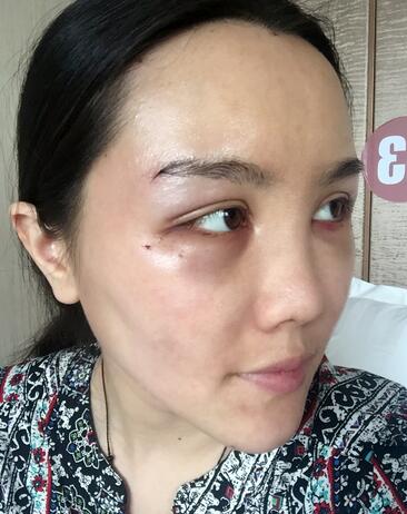 自体脂肪填充半年真实日记