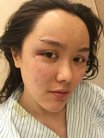 自体脂肪填充半年真实日记