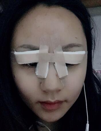 石家庄蓝山欧式芭比双眼皮经历
