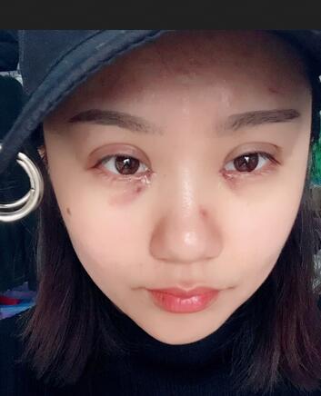 石家庄蓝山欧式芭比双眼皮经历