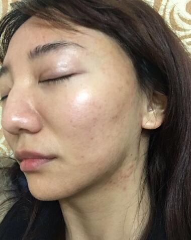 北京欧华去痘坑痘印两个月