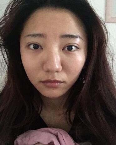 北京欧华去痘坑痘印两个月