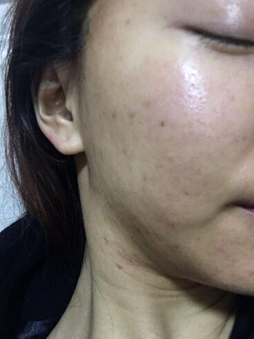 北京欧华去痘坑痘印两个月