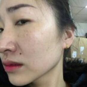 激光祛斑20天后的图片 北京欧华王芳