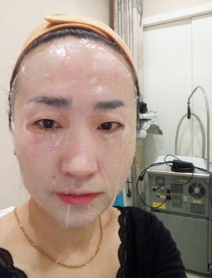激光祛斑20天后的图片 北京欧华王芳