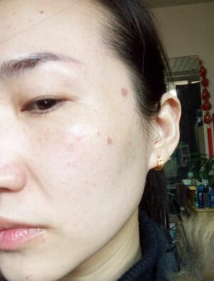 激光祛斑20天后的图片 北京欧华王芳