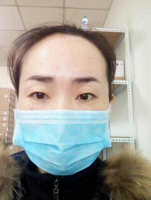 激光祛斑20天后的图片 北京欧华王芳