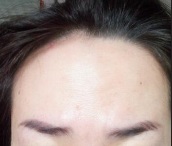 激光祛斑20天后的图片 北京欧华王芳