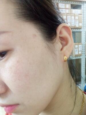 激光祛斑20天后的图片 北京欧华王芳